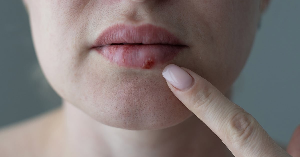 Después de casi treinta años, la FDA aprueba un antiviral oral que rompe la resistencia del herpes en pacientes con defensas bajas