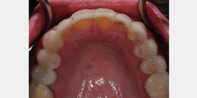 Carillas dentales: los signos que alertan sobre una filtración y cuándo actuar